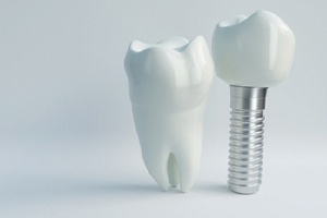 dental implant with crown next to natural tooth