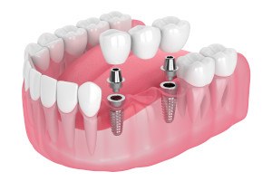 diagram of an implant bridge